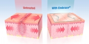 Neodyne Embrace skin closure product