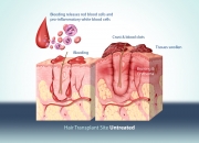 Hair transplant A untreated and with inflammatory response