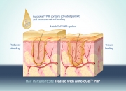 Hair transplant B treated with AutoloGel PRP