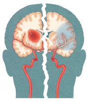 Stroke types