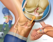 Anterior cruciate ligament injury and diagnosis