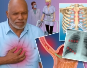 Acute Chest Pain