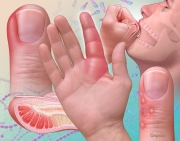 Acute Hand Inefctions