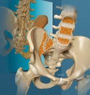 Spondyloarthropathies