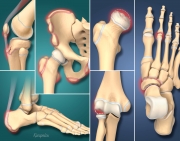 Apophysitis and Osteochondrosis