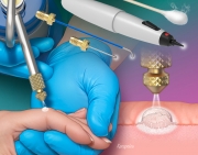 Cutaneous Cryosurgery for Skin Conditions