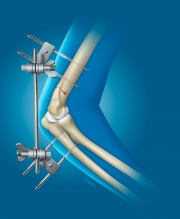 Repair of Elbow Fracture with External Fixation