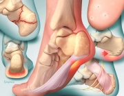 Heel Pain - Diagnosis and Management