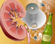 Medical management of kidney stones