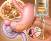 Pancreatic cancer medical management