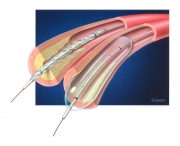 Balloon angioplasty in atherosclerotic artery