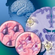 Lewy Body Dementia