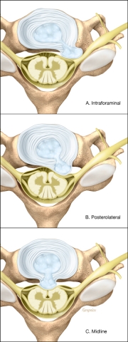 Three types of cervical disk herniations