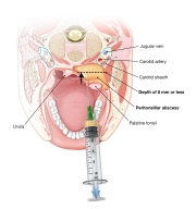 Peritonsillar abscess apiration depth