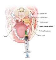 Peritonsillar abscess apiration depth