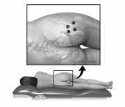 Botuninum toxin injection sites at hip