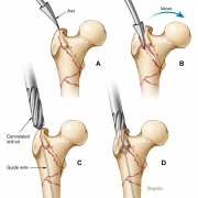 Femoral fracture surgical repair