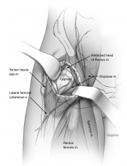 Anterior hip approach for total hip arthroplasty