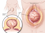 Incisional hernia repair 1