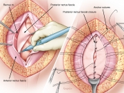 Incisional hernia repair 2