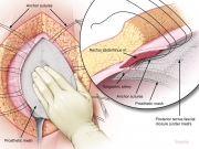 Incisional hernia repair 3