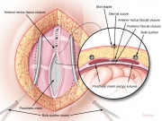 Incisional hernia repair 4