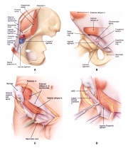 inguinal hernia surgical approach
