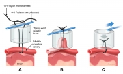 mechanical ligature of middle cerebral artery in rat