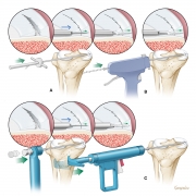 meniscus repair modalities