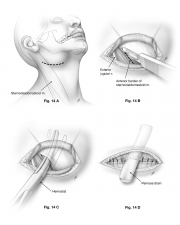 lateral neck abcess surgical procedure