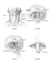 midline neck abcess surgical procedure