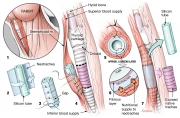 Neotrachea implant concept and method