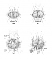 thyroidectomy procedure initial steps