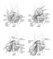 thyroidectomy procedure final steps