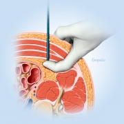 trochar insertion lateral to psoas muscle