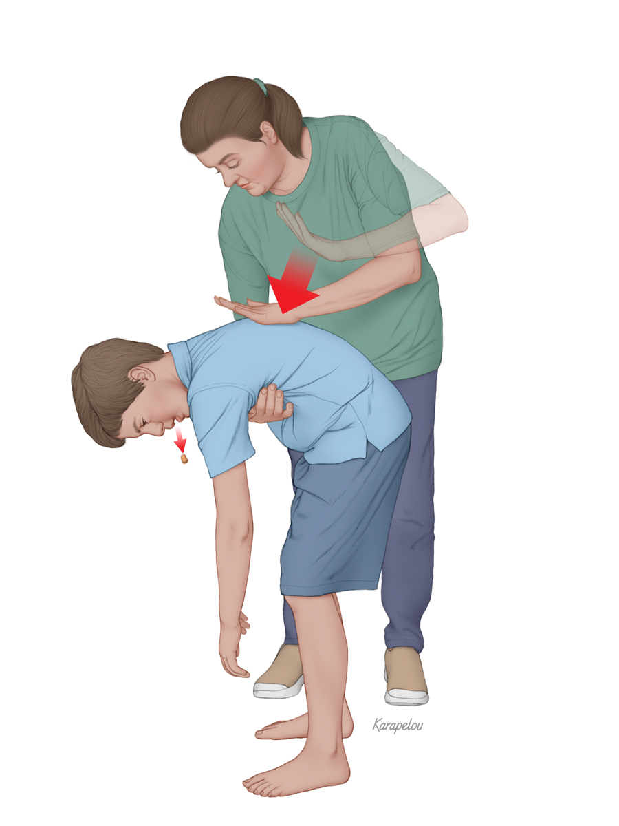 abdominal thrusts steps