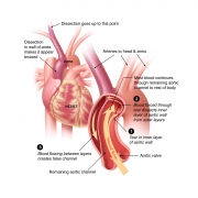 Aortic dissection at arch
