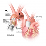 Surgical repair of aortic dissection