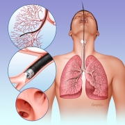 Bronchoscopy procedure