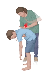 FIrst Aid for Choking - Back Blows