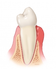 Gingivitis