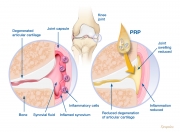 Osteoarthritis and PRP treatment concept