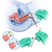 Pap (cervical) smear test procedure
