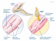 Tendinopathy and PRP treatment concept