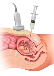 Amniocentesis procedure