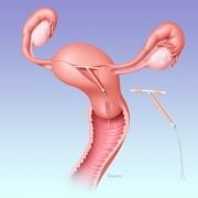 Contraceptive intrauterine device