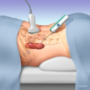 Kidney biopsy procedure