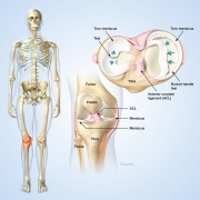 Meniscus cartilage tears