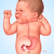 Pyloric Stenosis in Infant