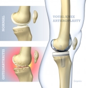 Total knee arthroplasty basic concept